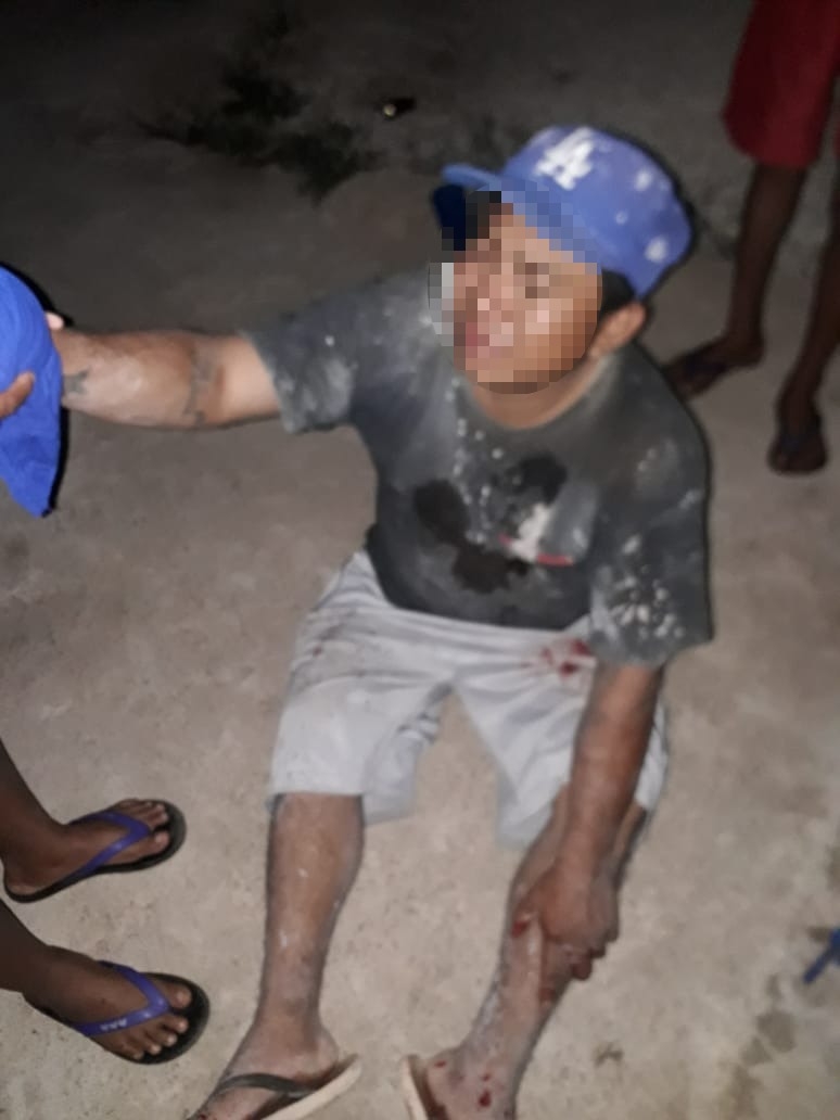 Joven sufre quemaduras por jugar con pirotecnia en Akíl, Yucatán