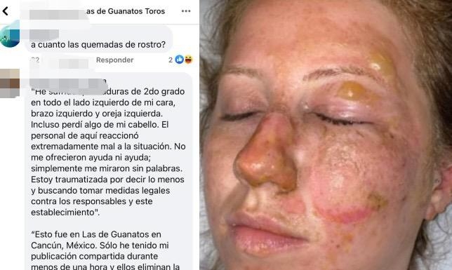 Usuarios de redes sociales arremeten contra ‘Las de Guanatos’ tras quemaduras a turista