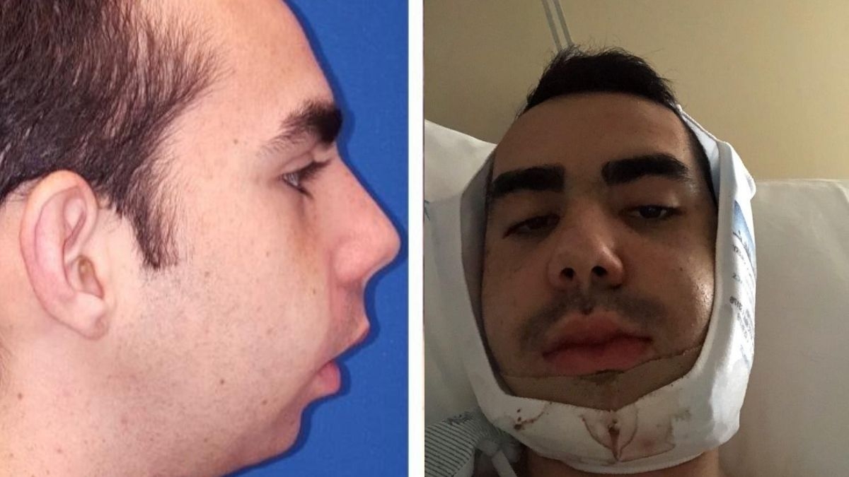 Usuario de TikTok realiza nueve cirugías en su rostro y muestra el increíble resultado: VIDEO