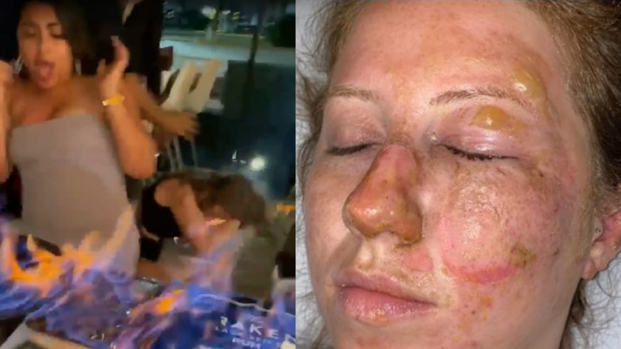 Turista sufre graves quemaduras por bebida flameada en 'Las de Guanatos' de Cancún