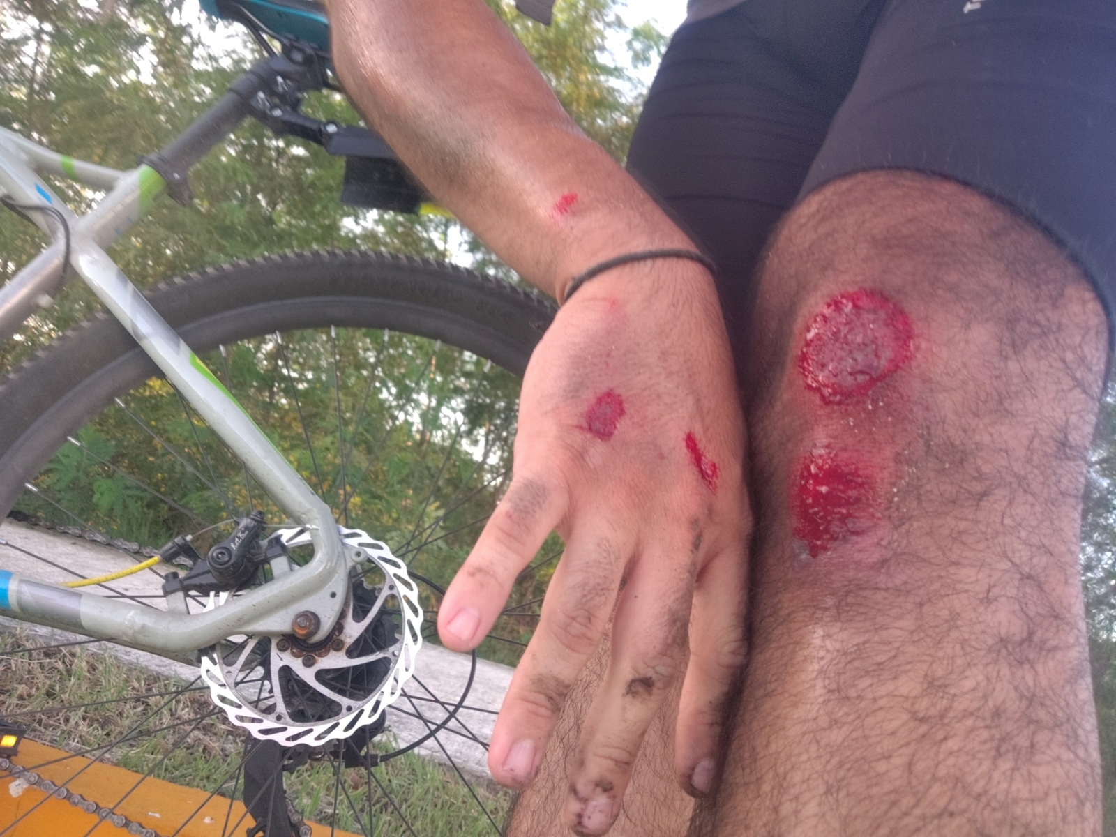 Joven yucateco termina lesionado tras ser derribado en su bicicleta por un corredor