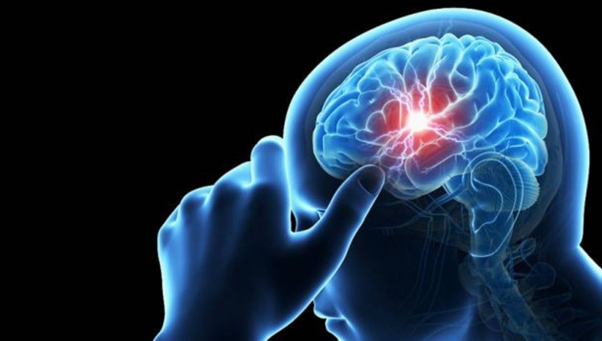 ¿Qué es un aneurisma cerebral? Todo sobre la enfermedad mortal y silenciosa