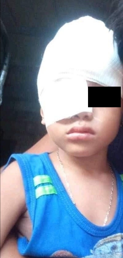 J. M. P. M de 4 años fue atacado en el rostro por un perro raza pitbull