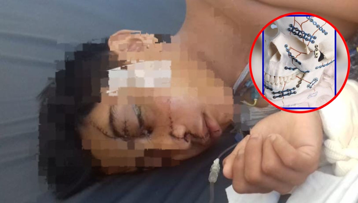 Joven de 16 años, grave en hospital de Mérida tras accidente en motocicleta