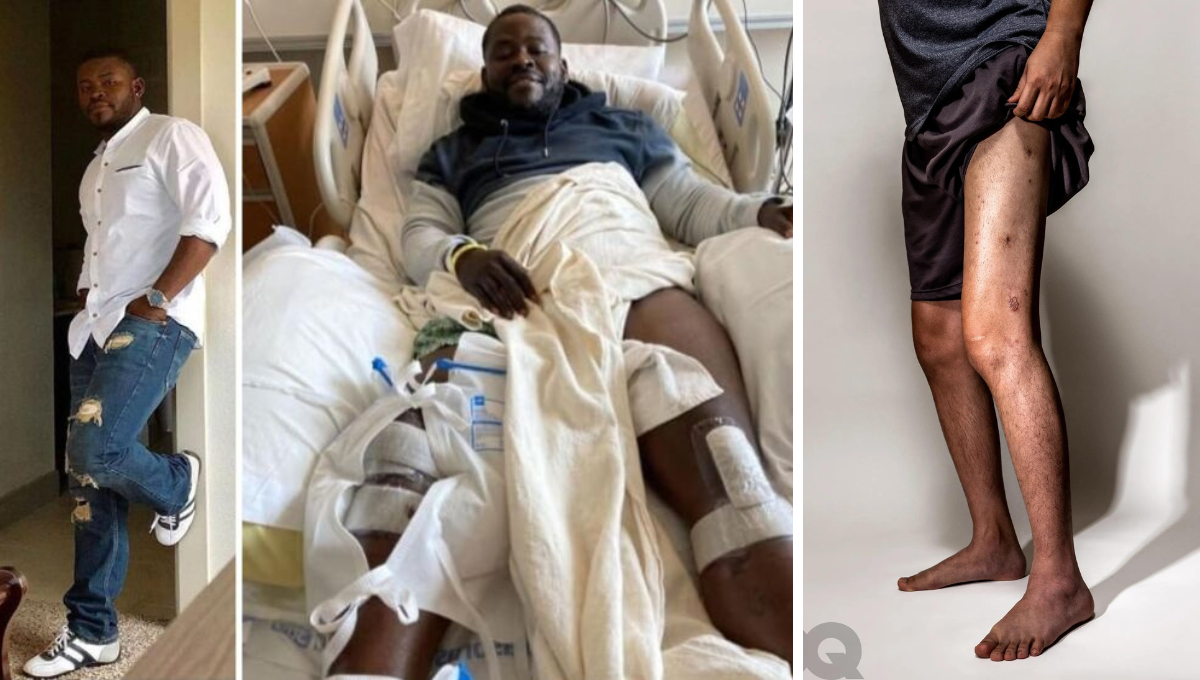 Hombre gasta 1 millón de pesos para alargarse las piernas en Atlanta, EU