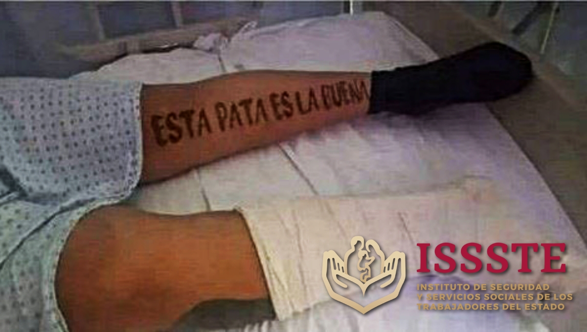 Médicos del ISSSTE le amputan la pierna equivocada a una paciente en San Luis Potosí