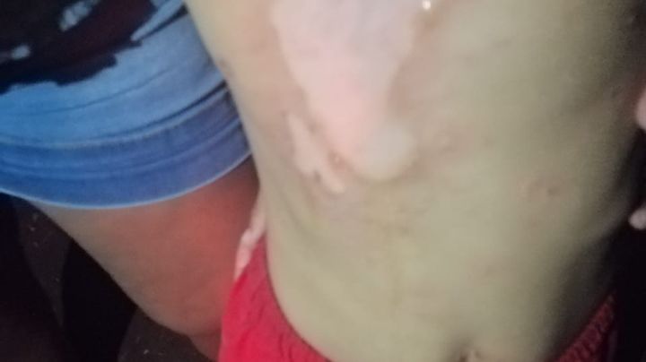 Niño es quemado por un petardo en Tizimín
