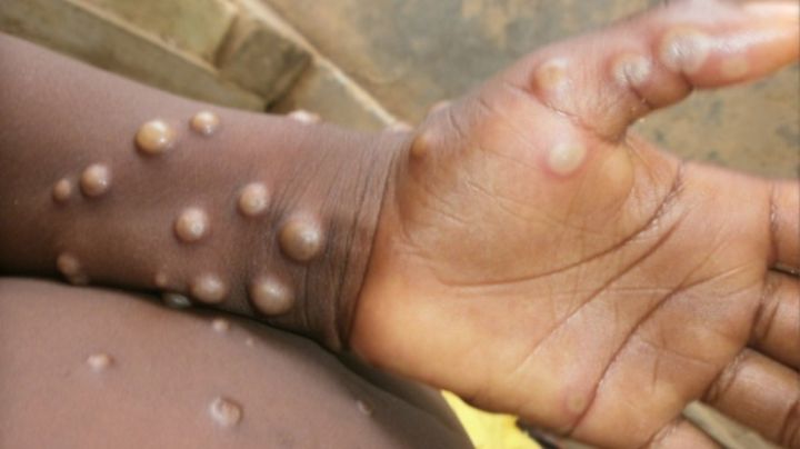 La OMS eleva a 131 los casos de viruela del mono en varios países