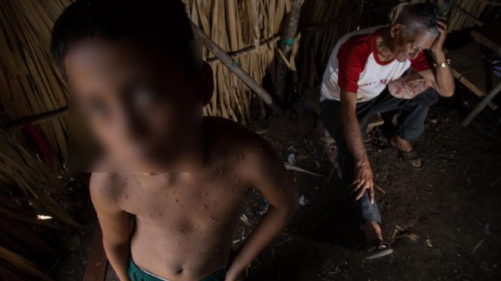 Yucatán, en la posición 14 en casos de varicela en México: SSA