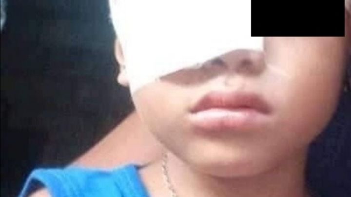 Niño atacado por un pitbull en Buctzotz pide apoyo para una cirugía
