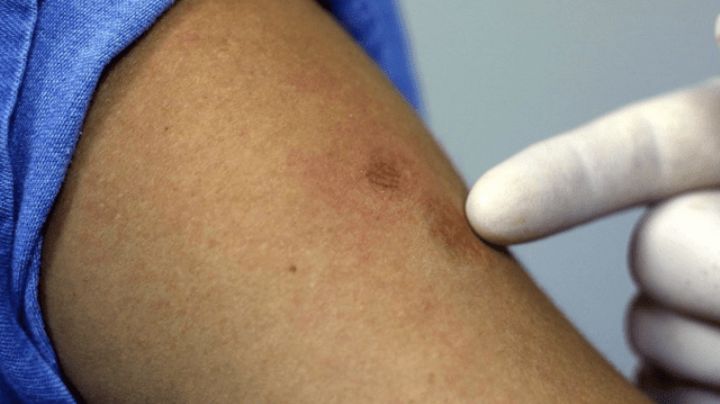 Conasida toma medidas para prevenir contagios de viruela de mono en personas con VIH