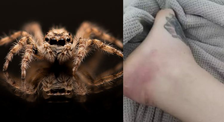 Una mujer fue picada por una araña, pero al final perdió la pierna